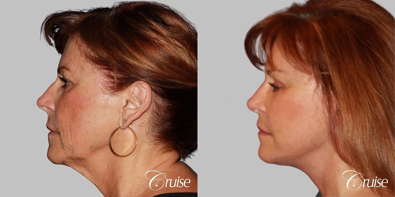 Neck Lift Before & After