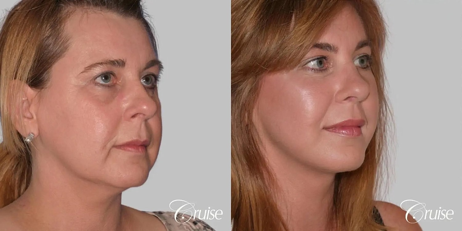 Neck Lift Before & After