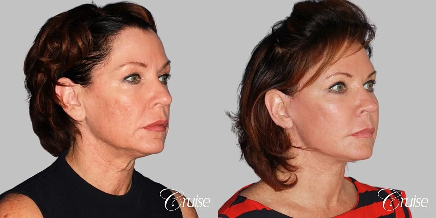 Neck Lift Before & After
