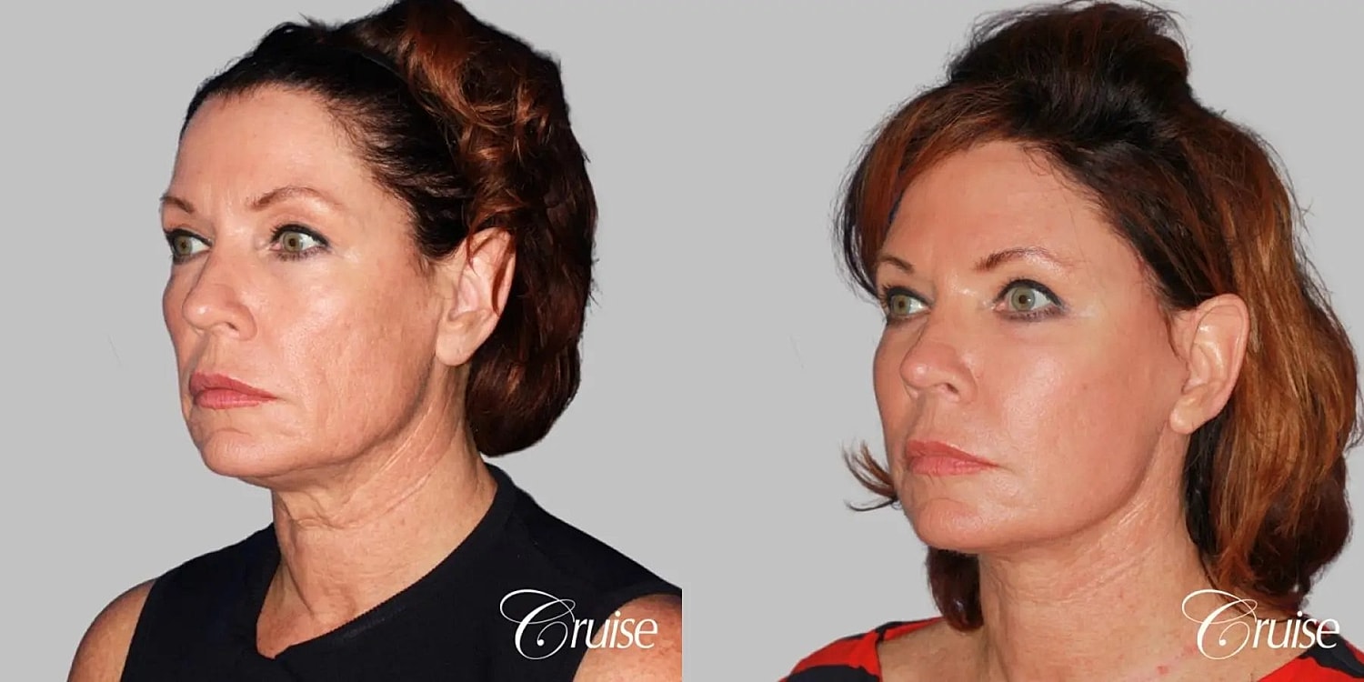 Neck Lift Before & After