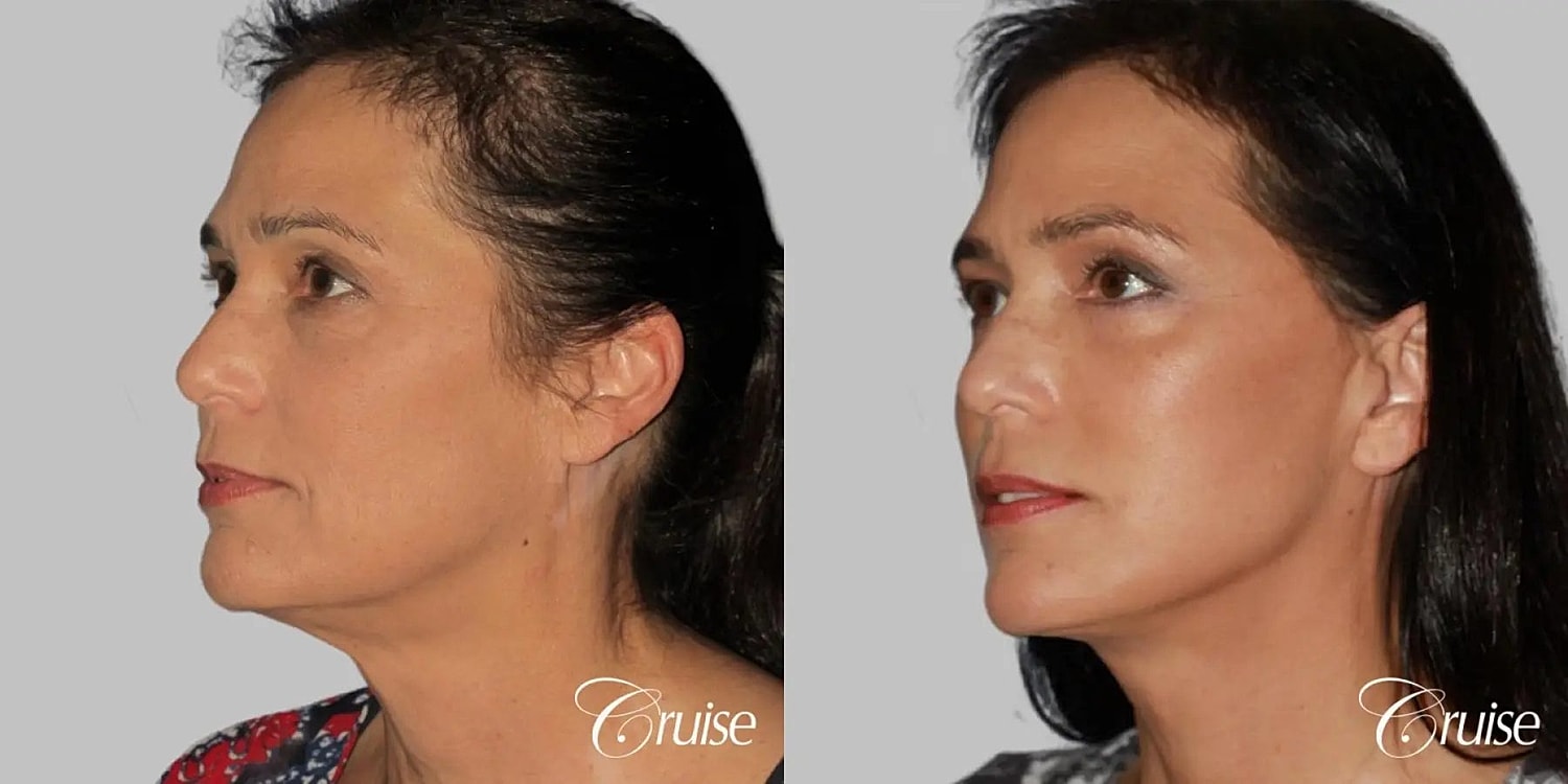 Neck Lift Before & After