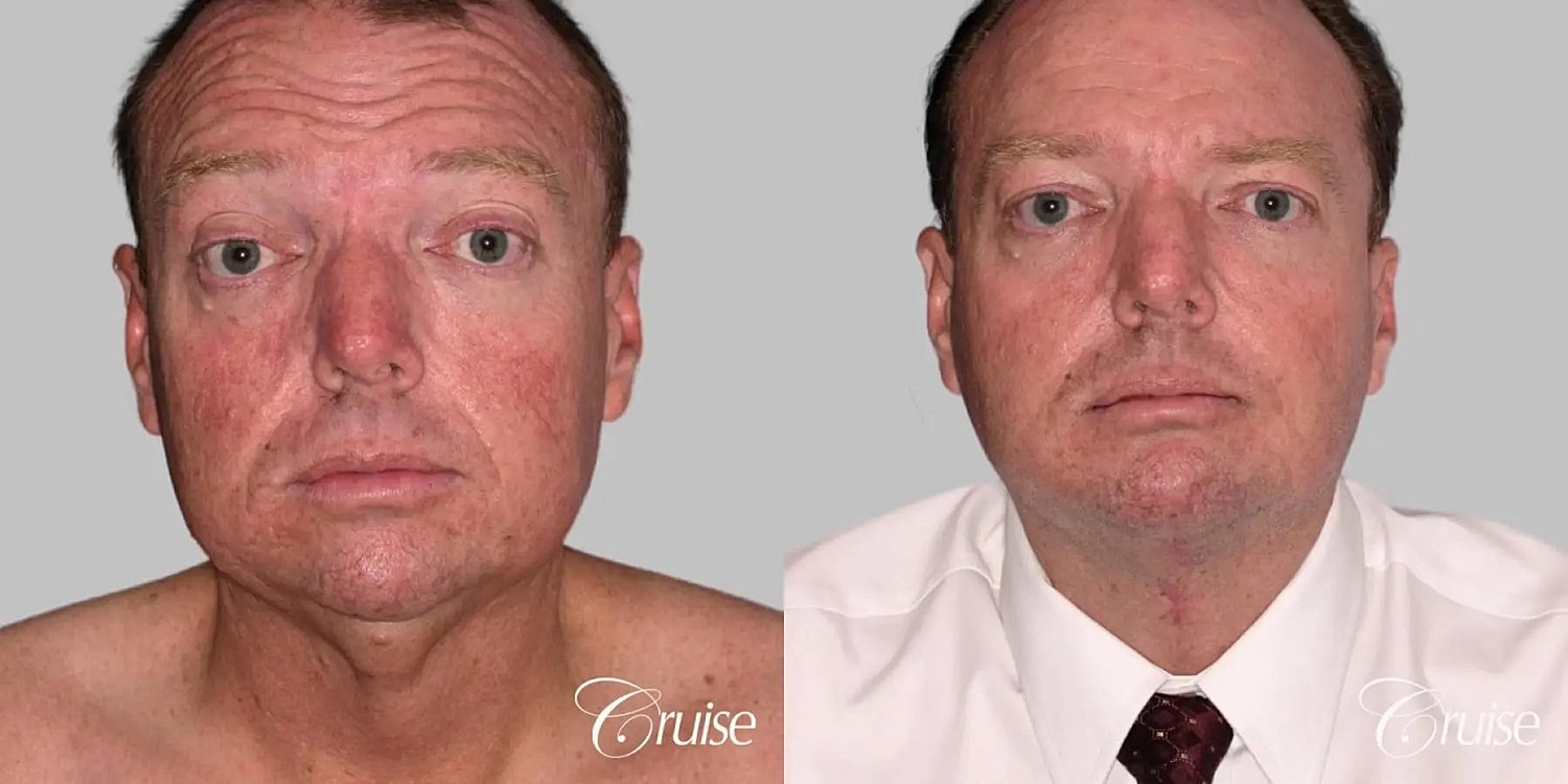 Neck Lift Before & After