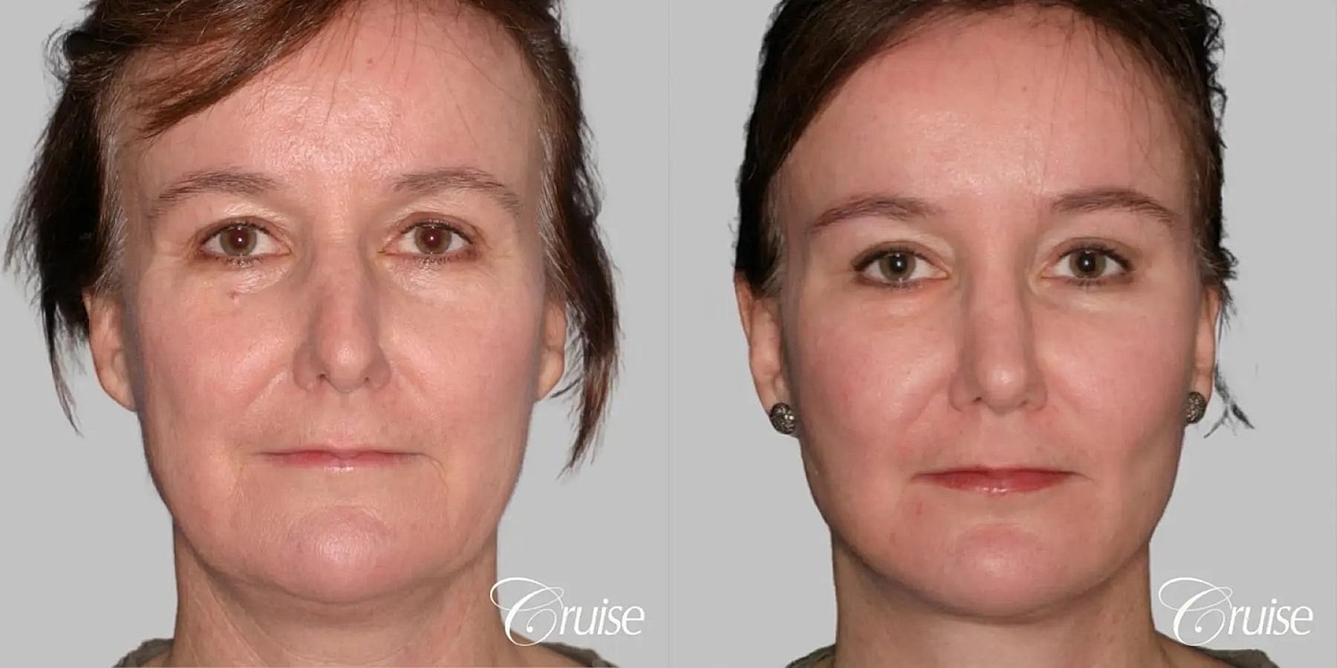 Neck Lift Before & After