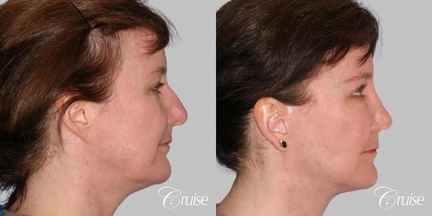 Neck Lift Before & After