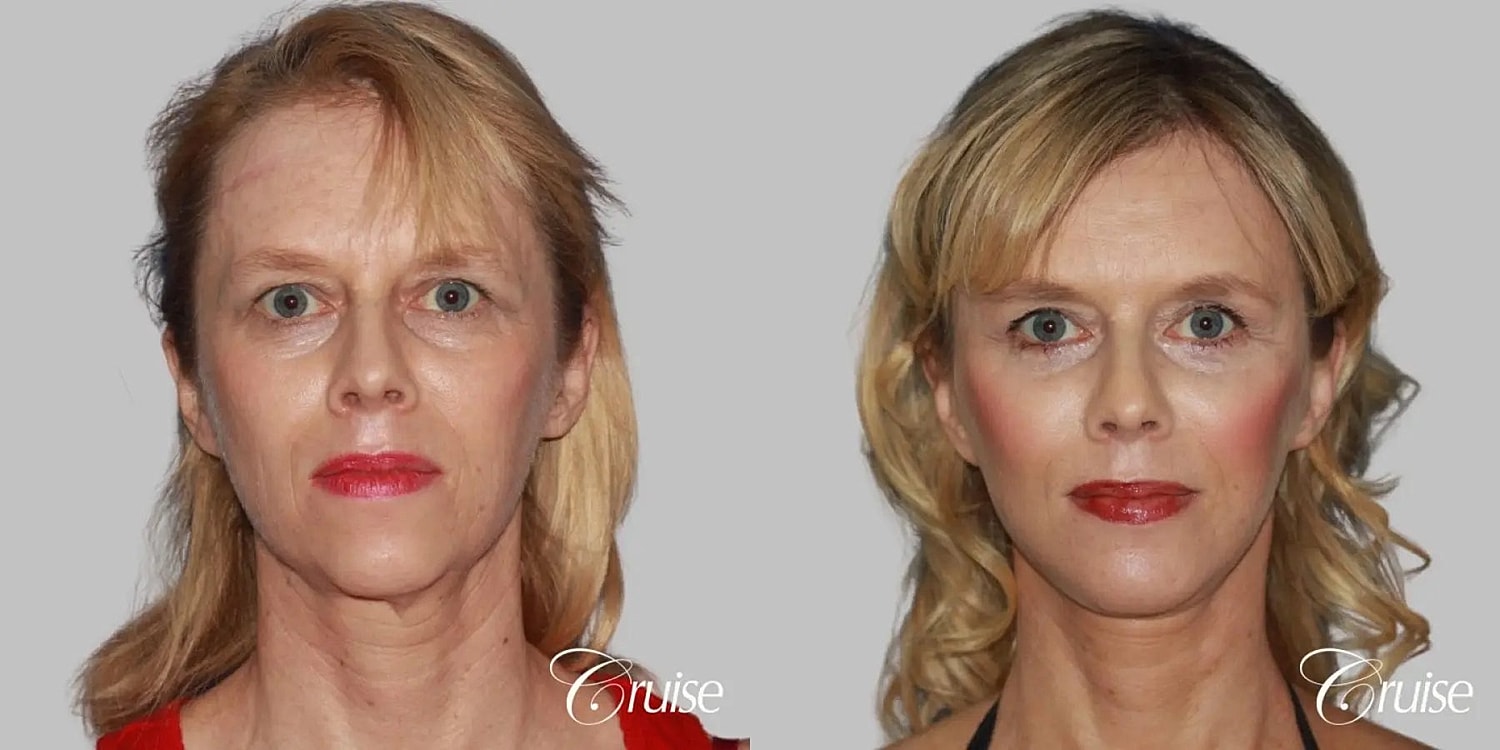 Neck Lift Before & After