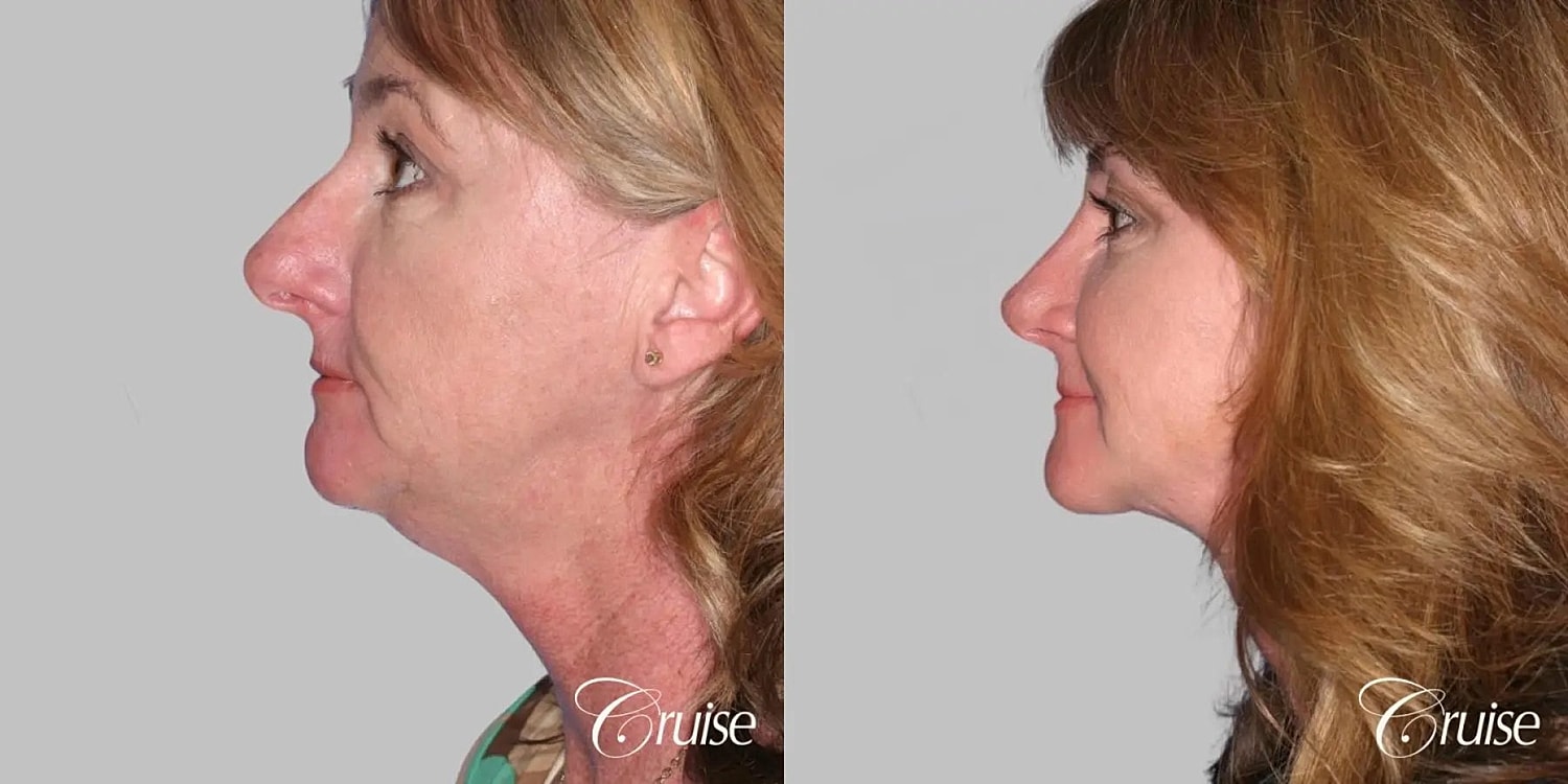 Neck Lift Before & After