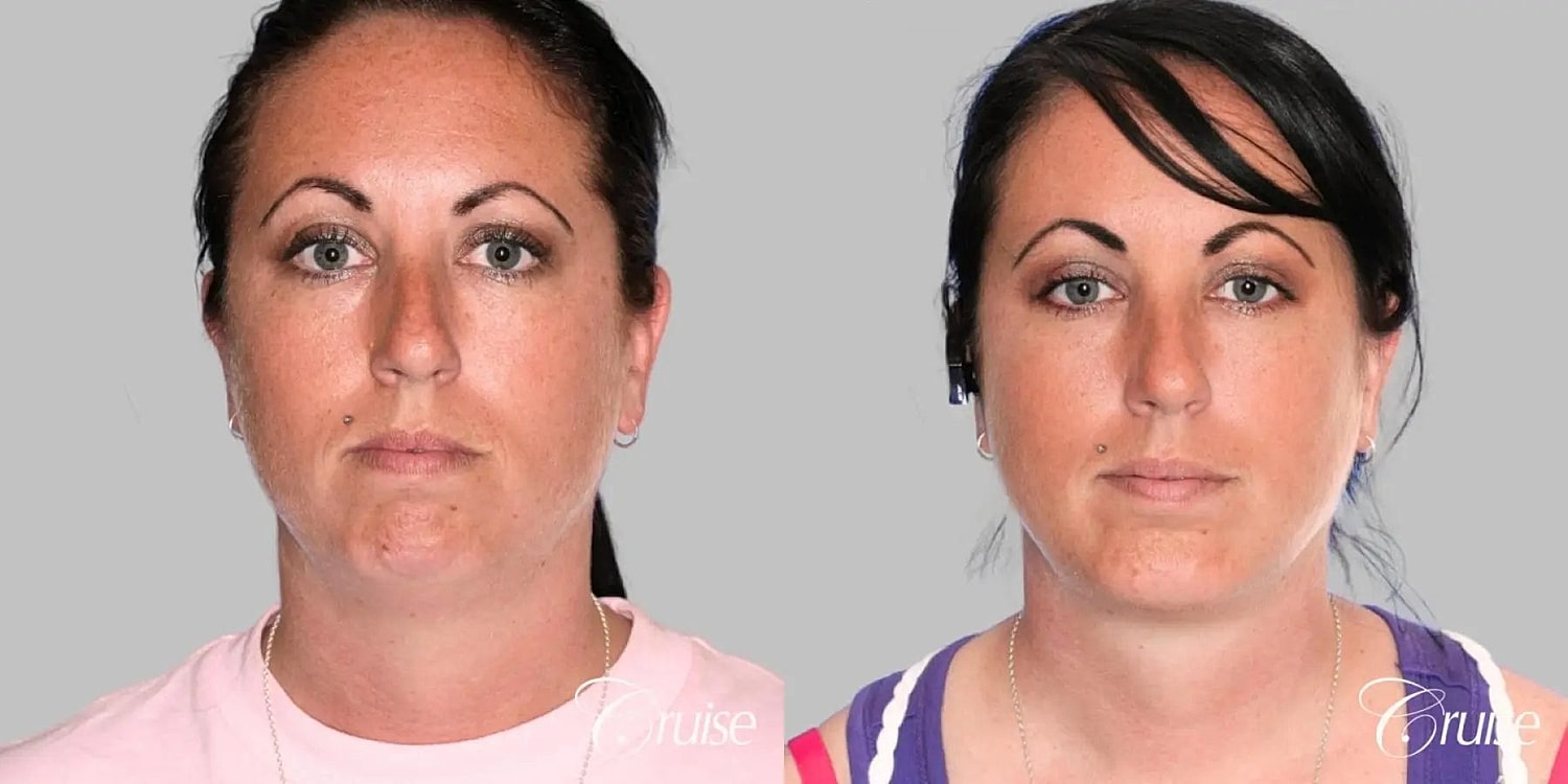 Neck Lift Before & After