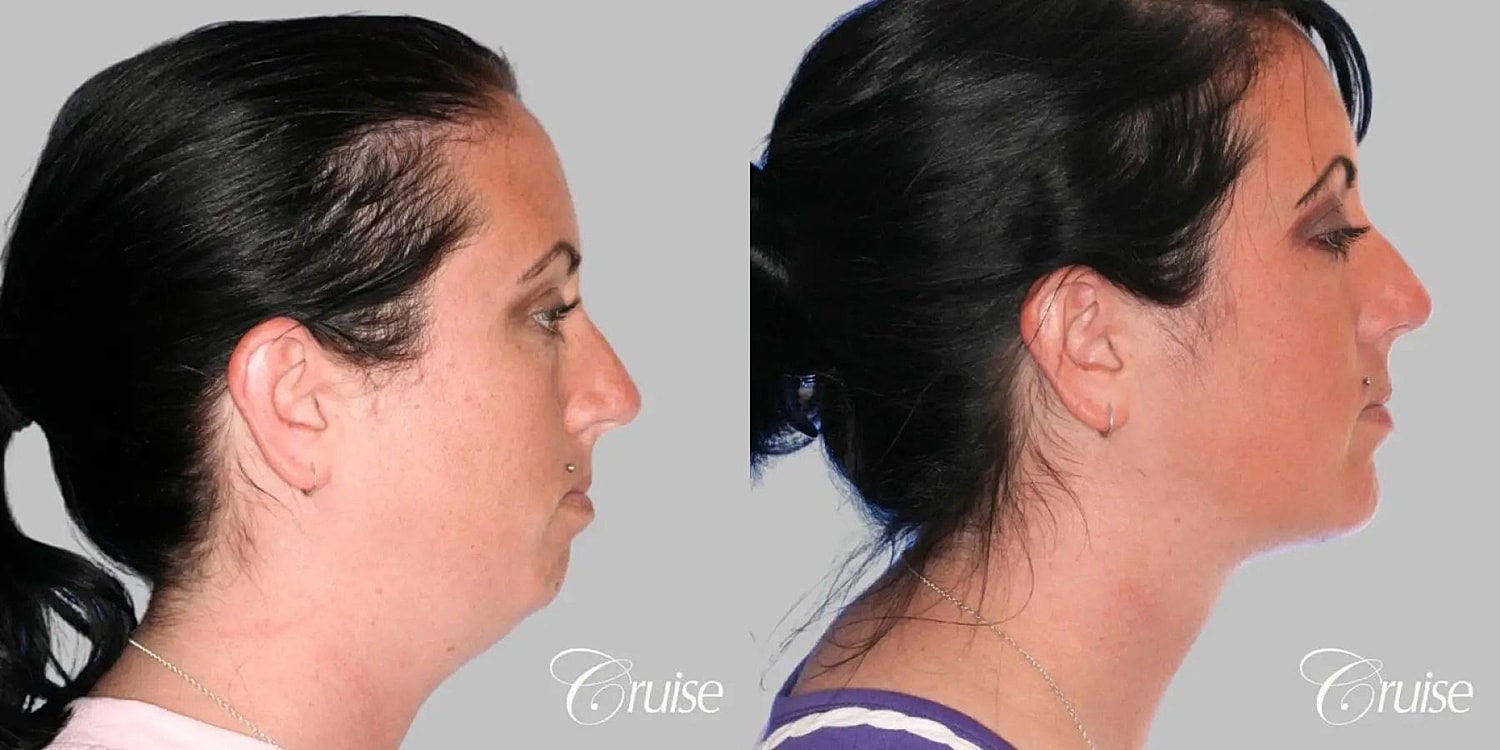 Neck Lift Before & After