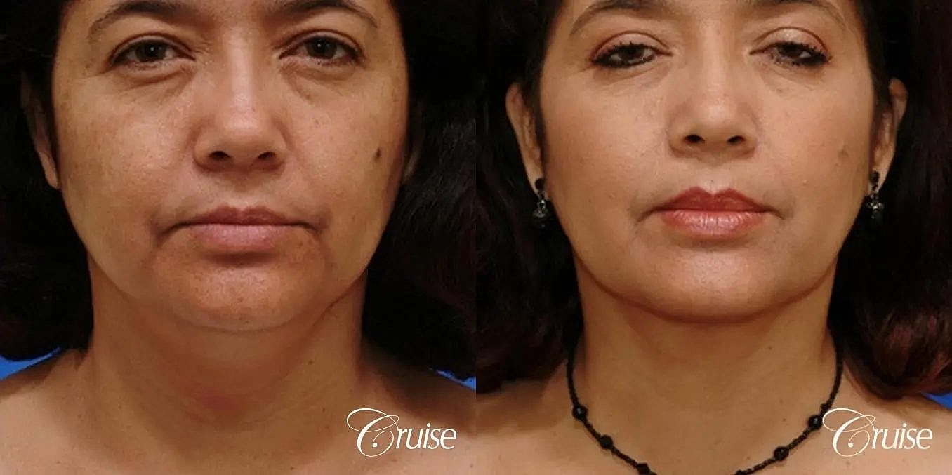 Neck Lift Before & After