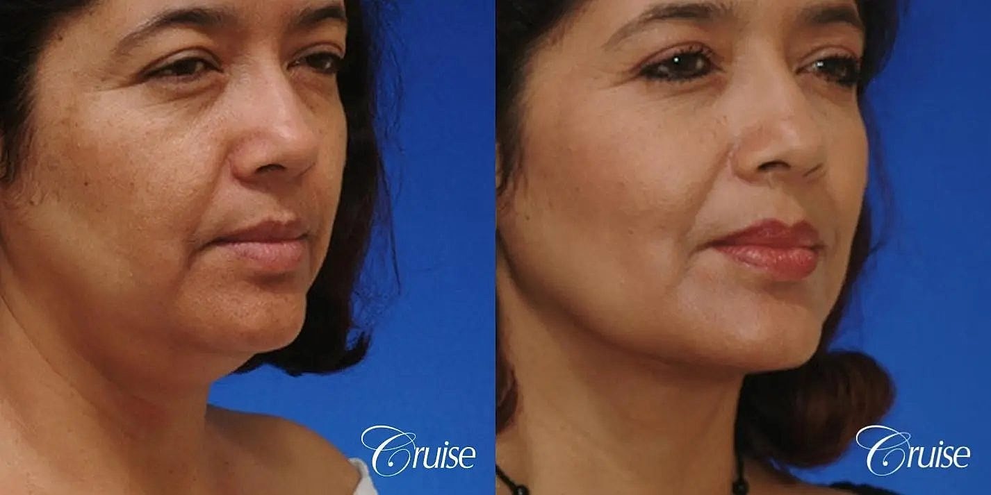 Neck Lift Before & After