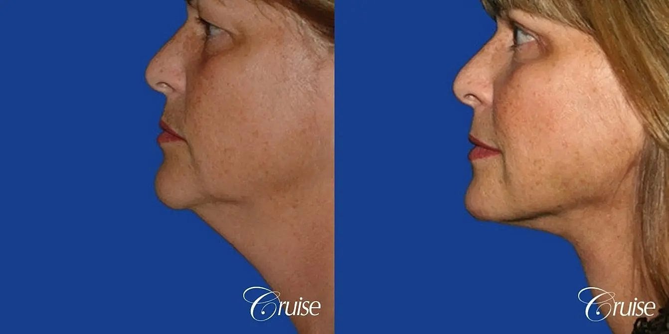 Neck Lift Before & After