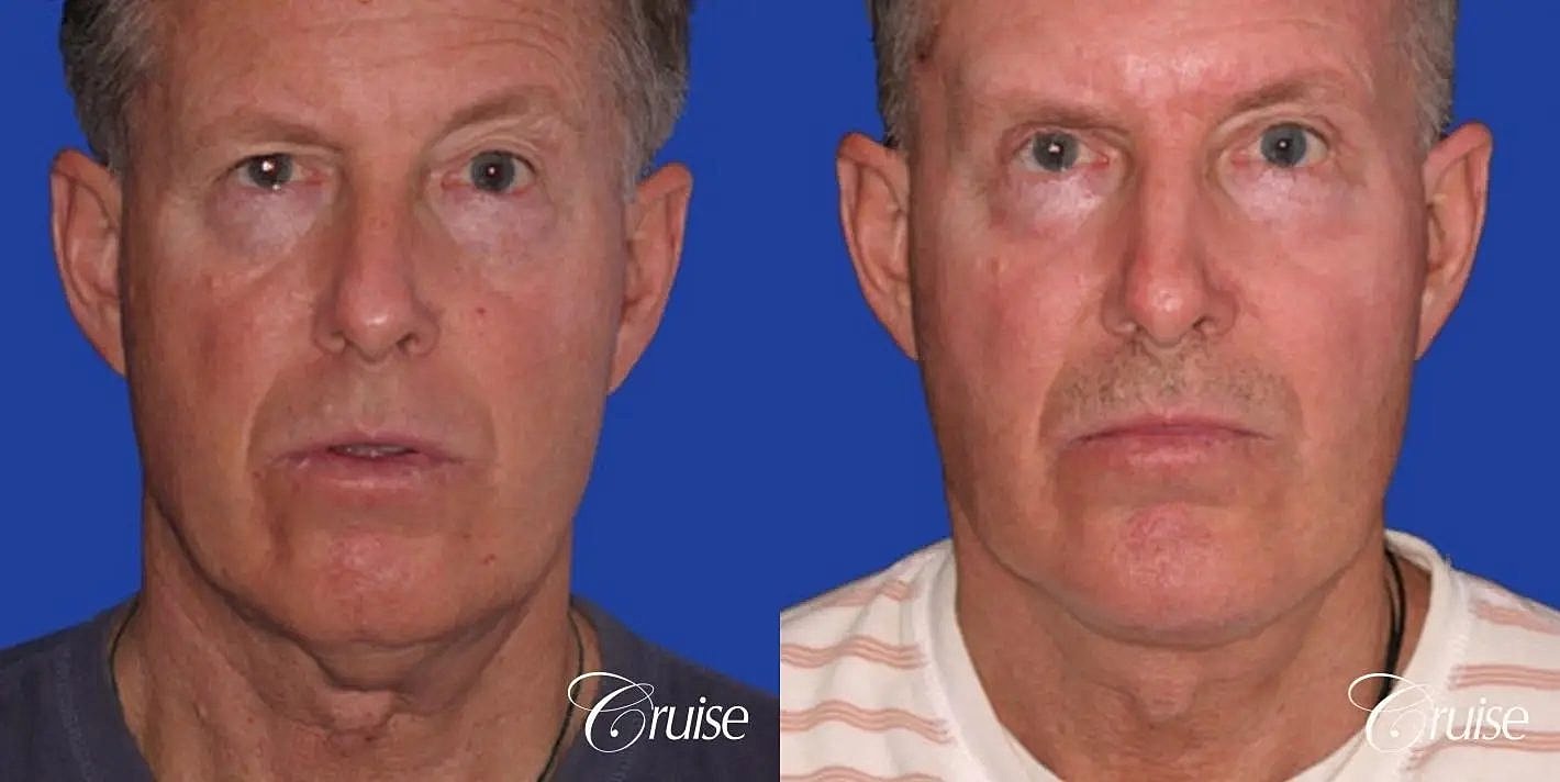 Neck Lift Before & After