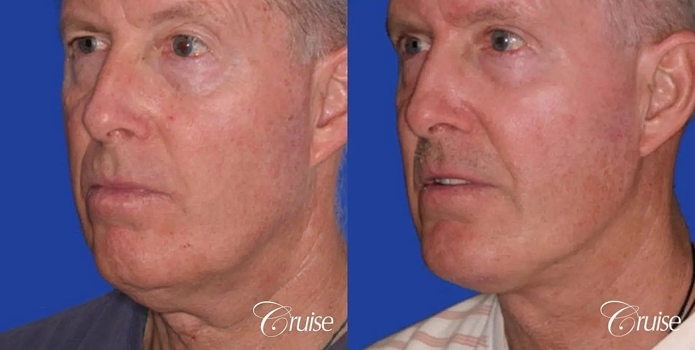 Neck Lift Before & After