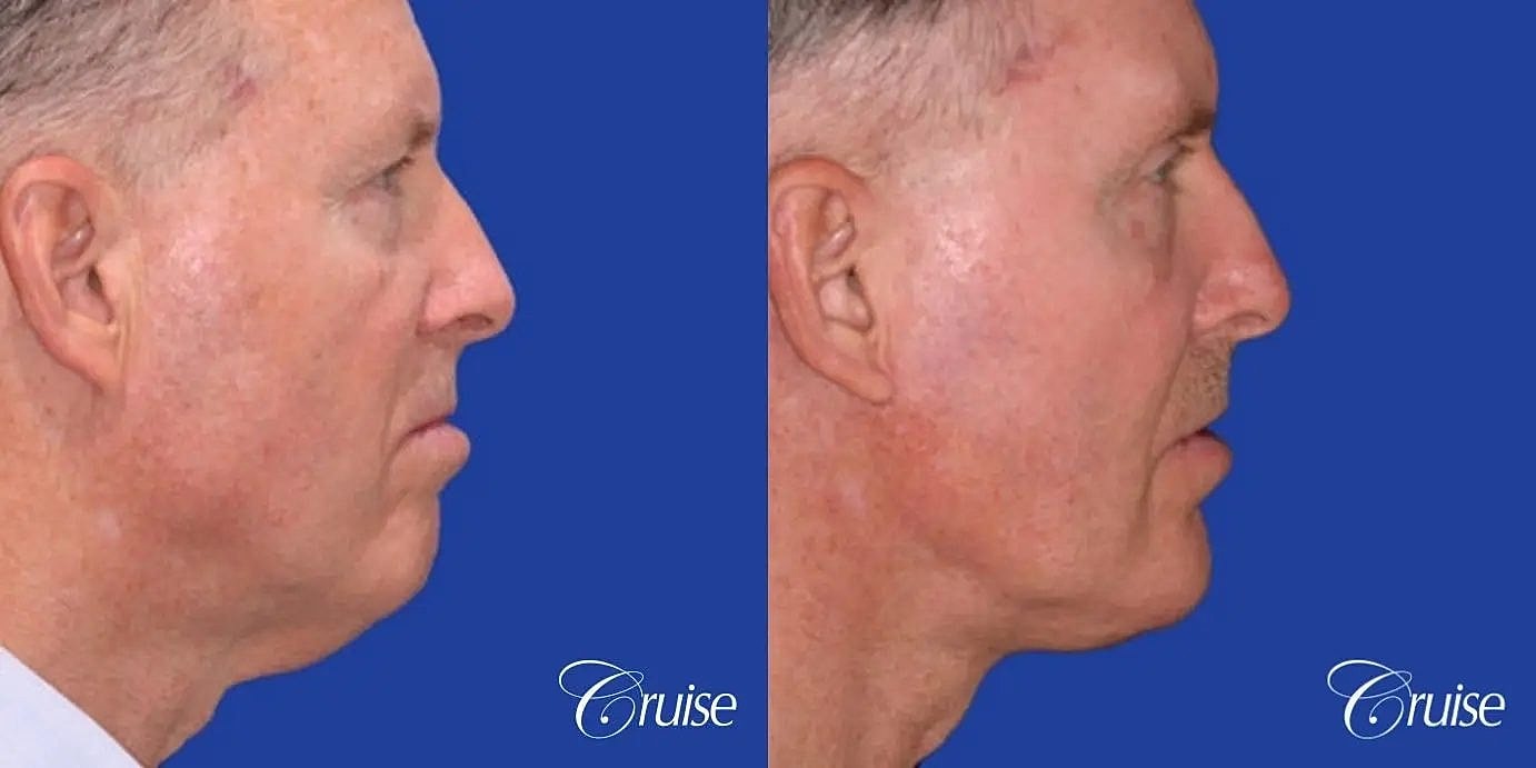Neck Lift Before & After