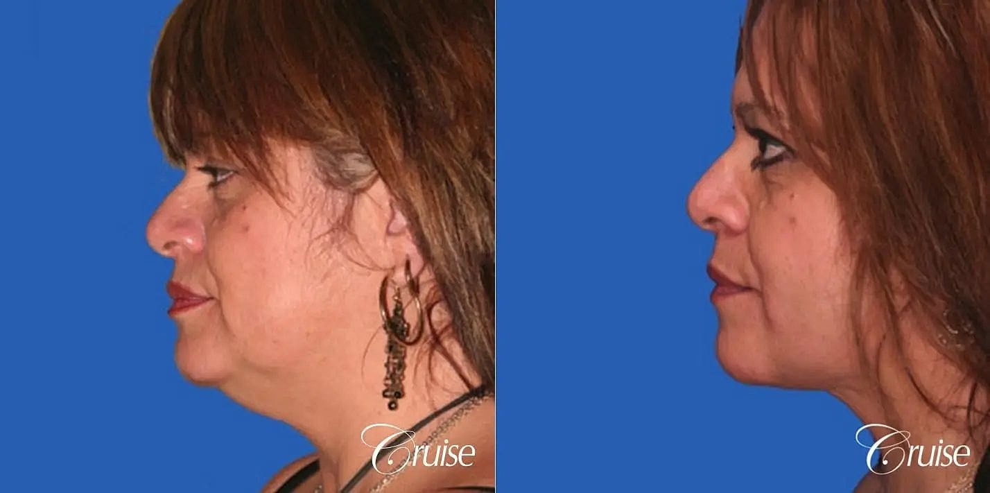 Neck Lift Before & After