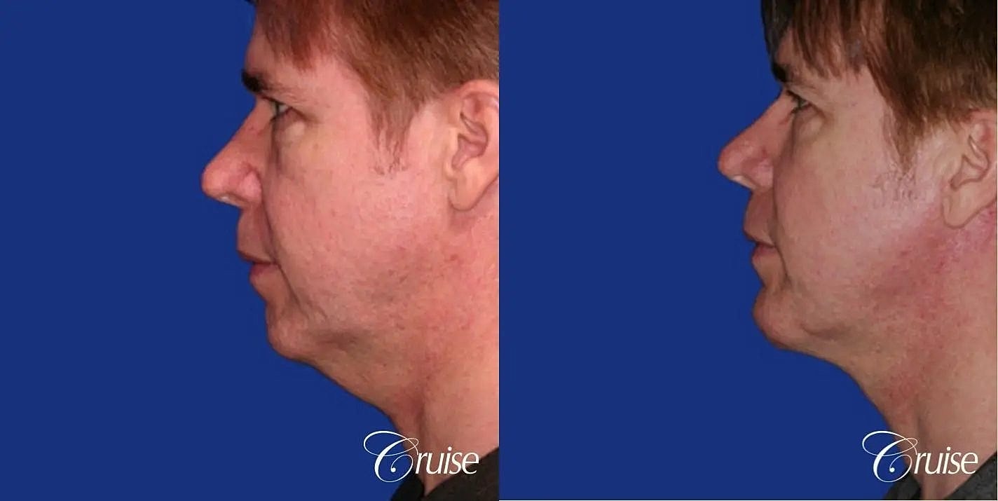 Neck Lift Before & After
