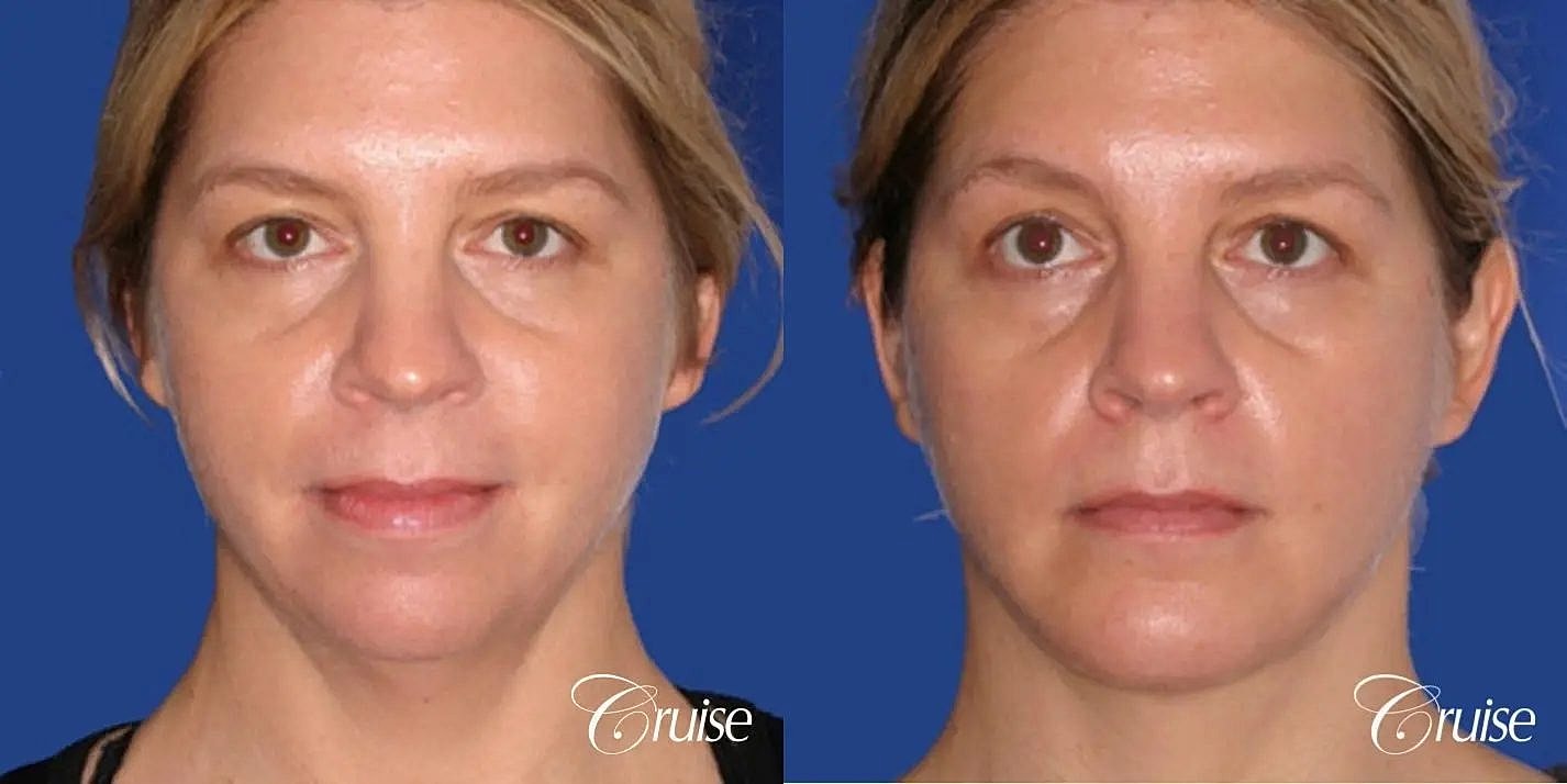 Neck Lift Before & After