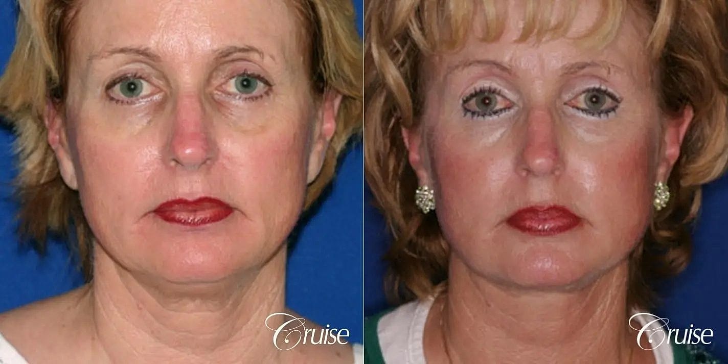 Neck Lift Before & After