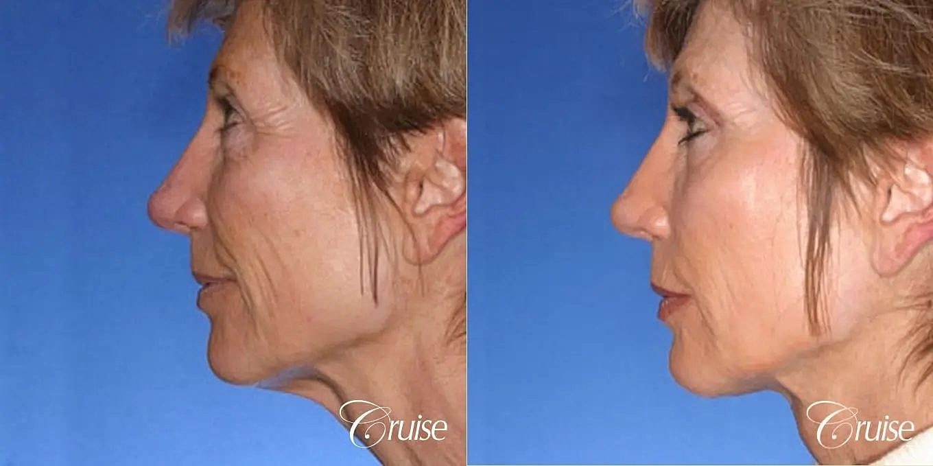 Neck Lift Before & After