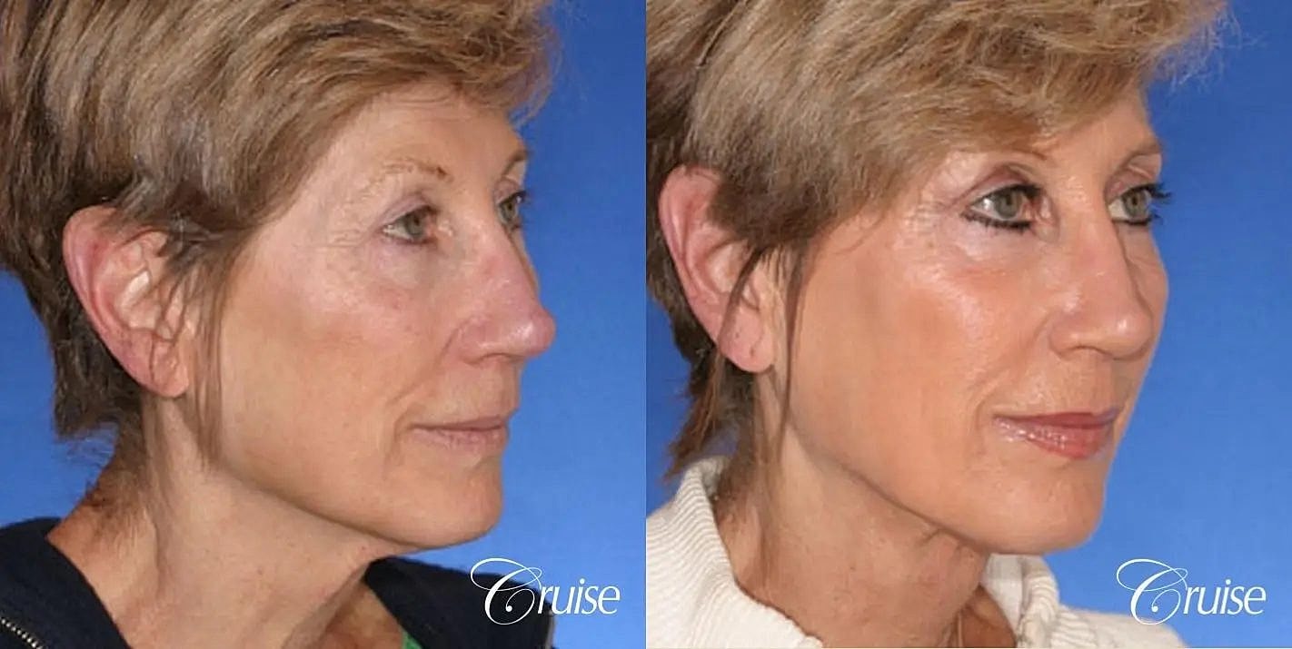 Neck Lift Before & After