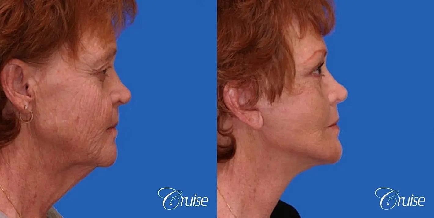 Neck Lift Before & After