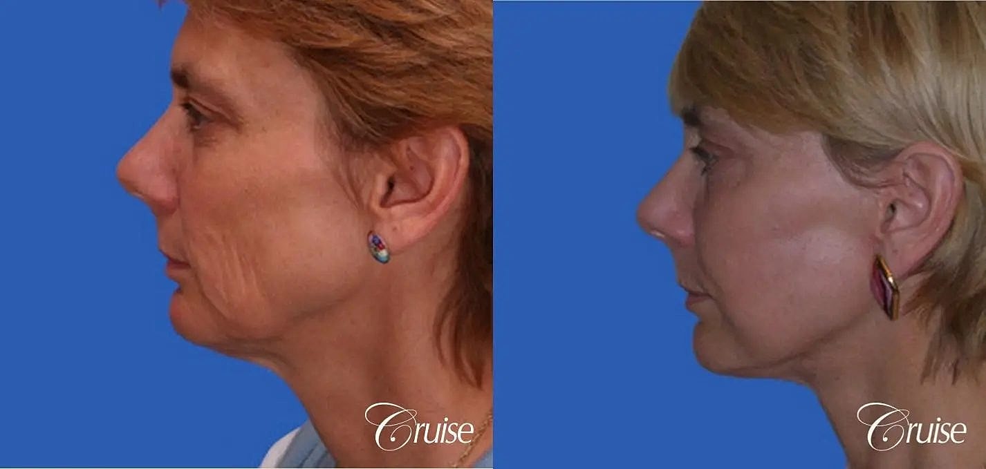 Neck Lift Before & After