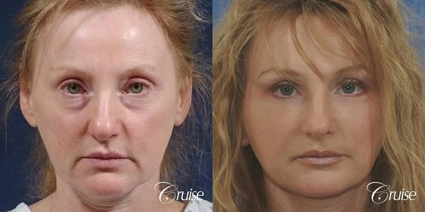 Neck Lift Before & After