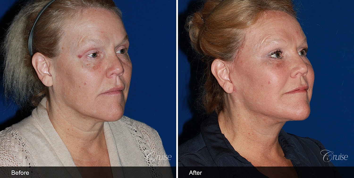 Neck Lift Before & After