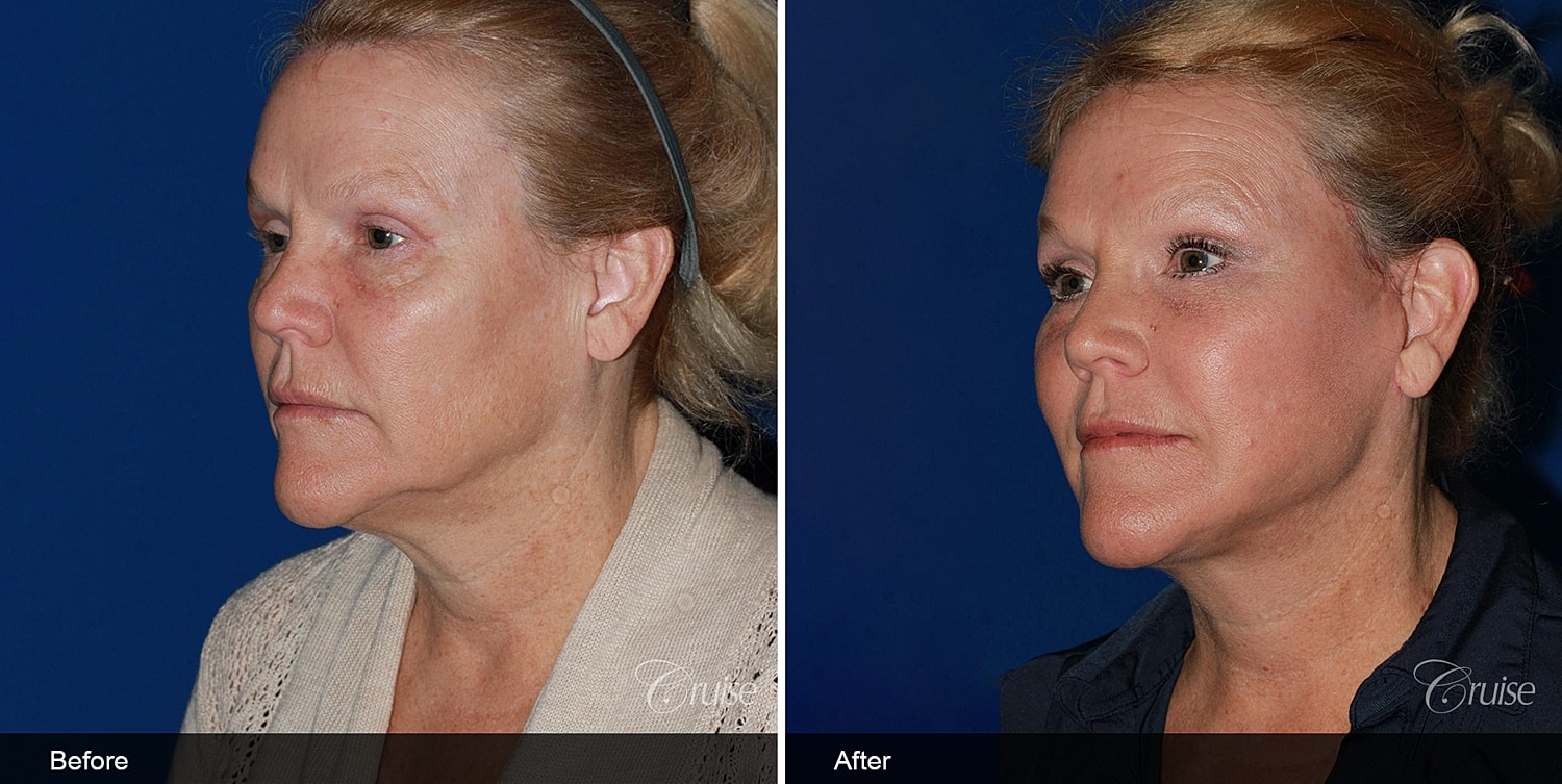 Neck Lift Before & After