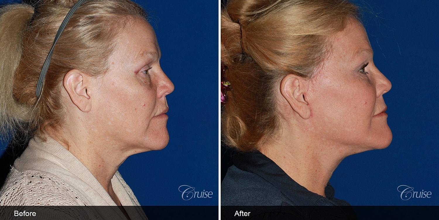 Neck Lift Before & After