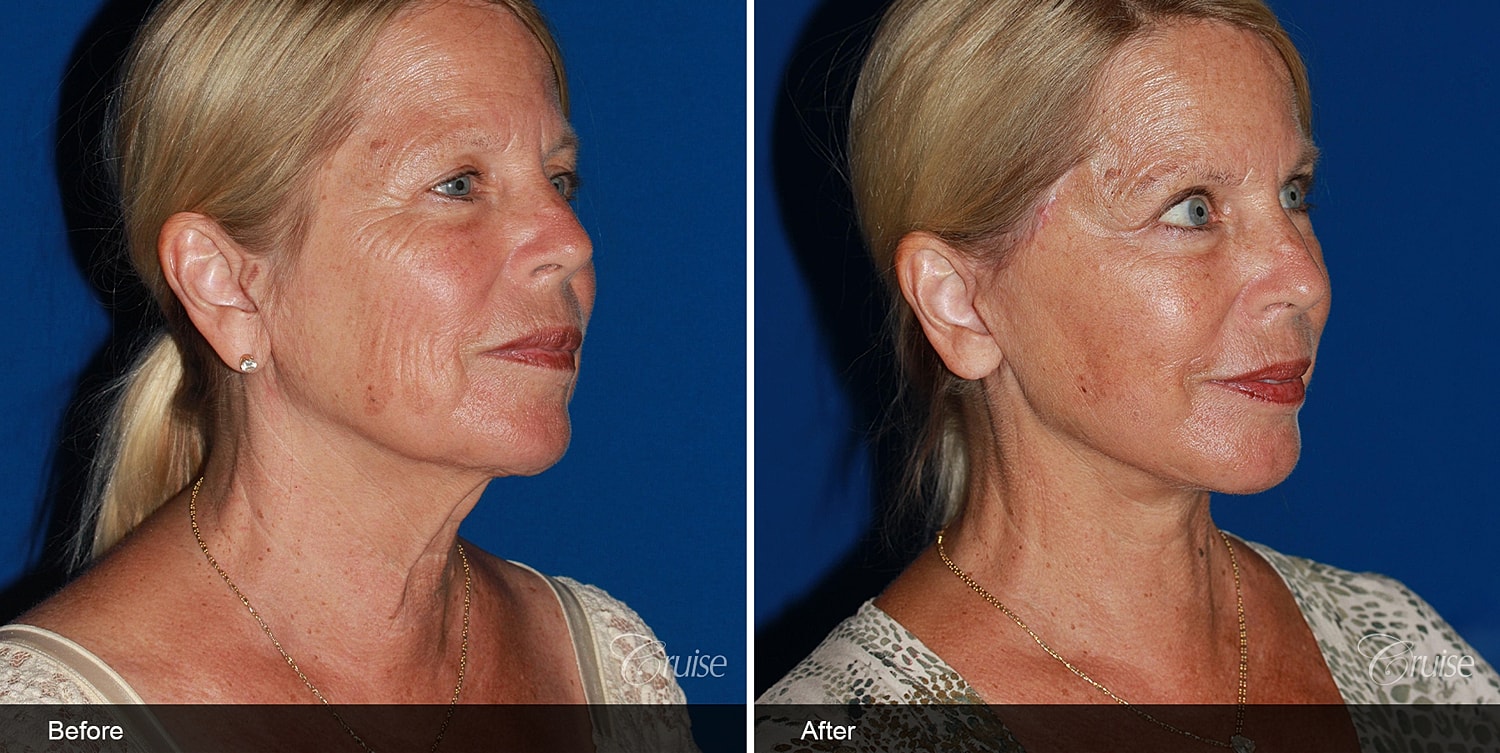 Neck Lift Before & After