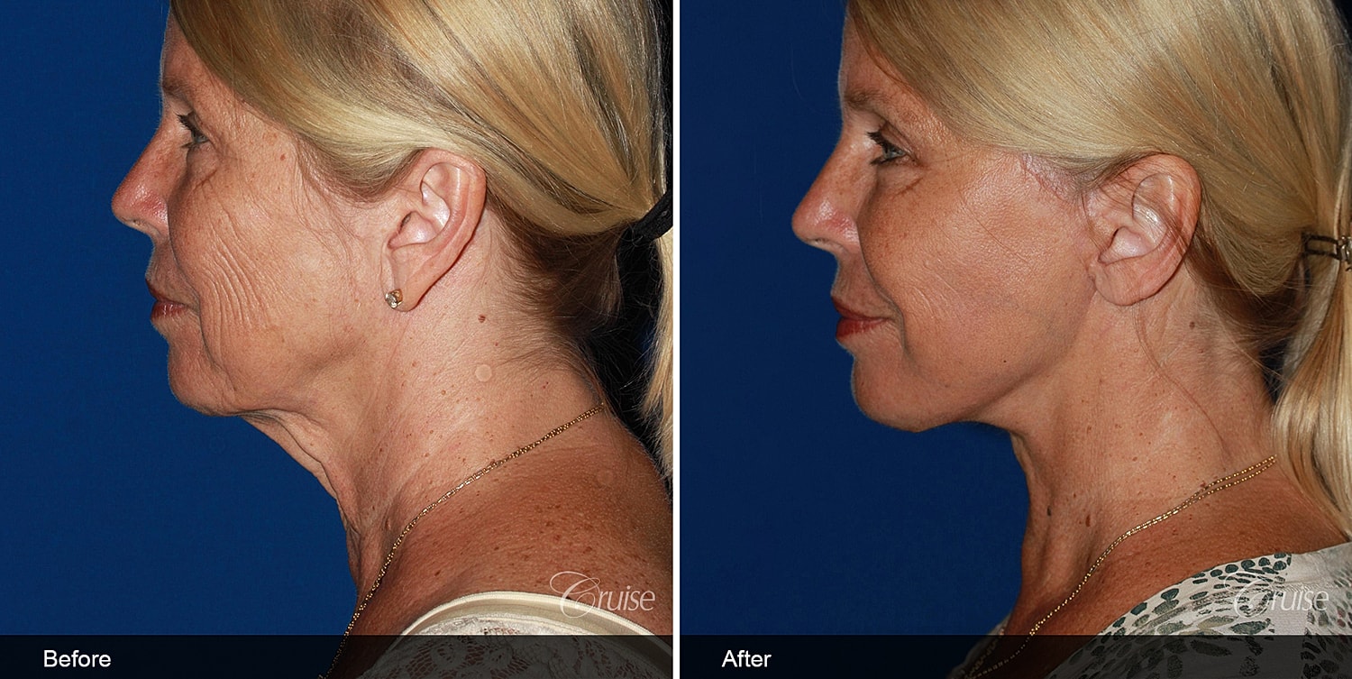 Neck Lift Before & After