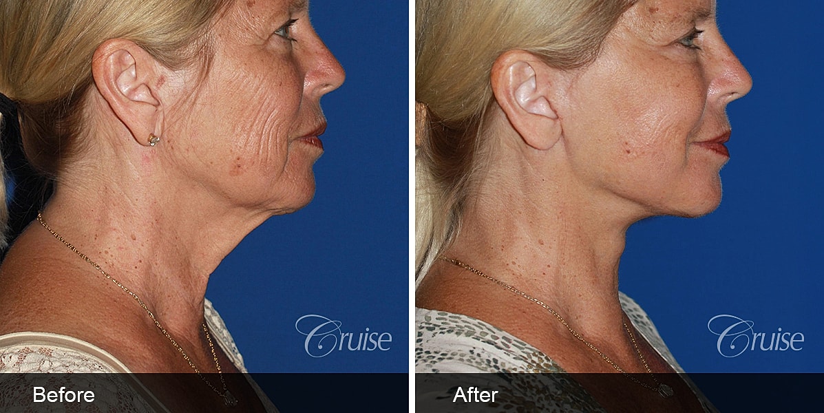 Neck Lift Before & After