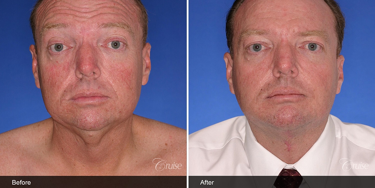 Neck Lift Before & After