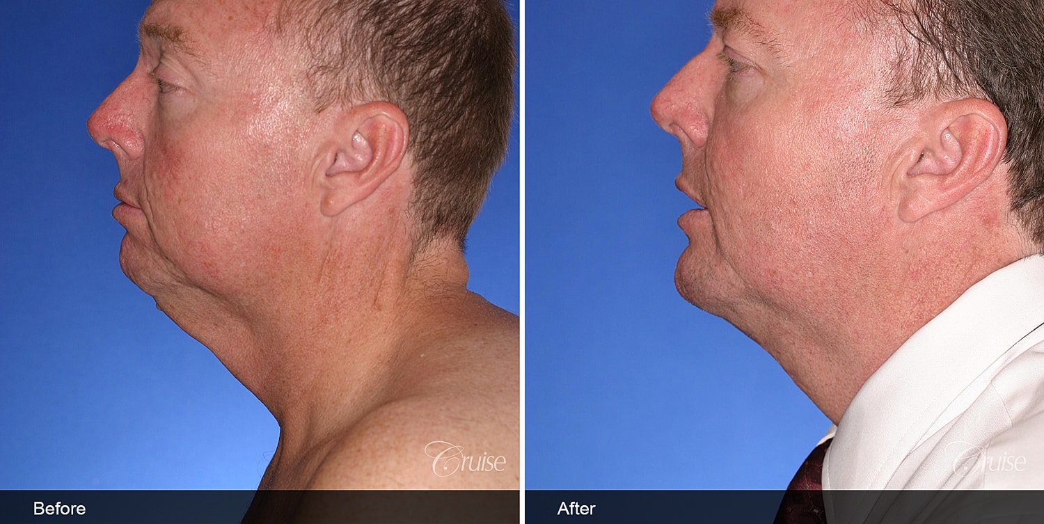 Neck Lift Before & After