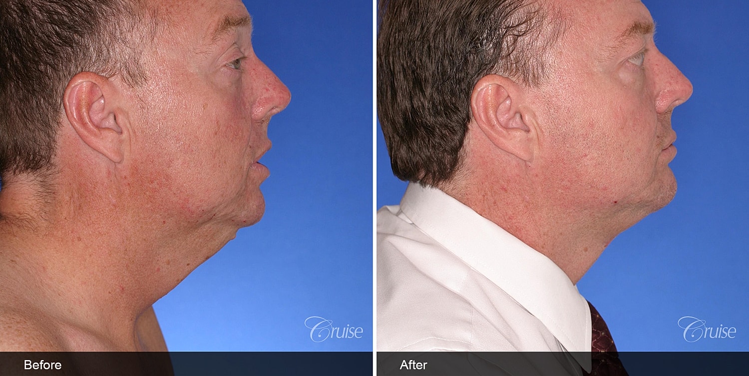 Neck Lift Before & After
