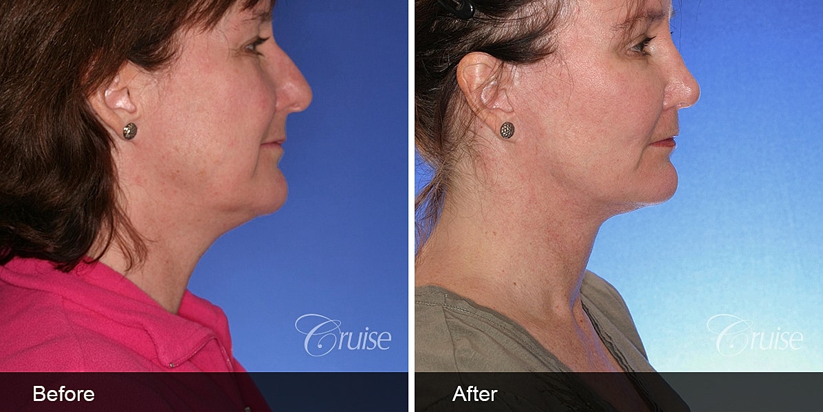 Neck Lift Before & After