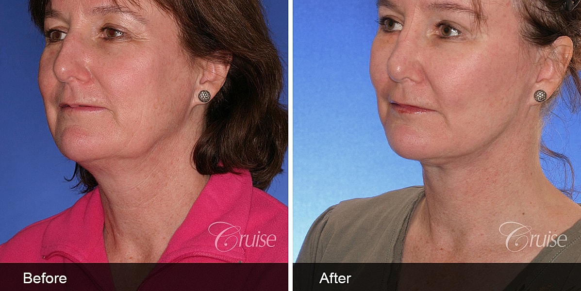 Neck Lift Before & After