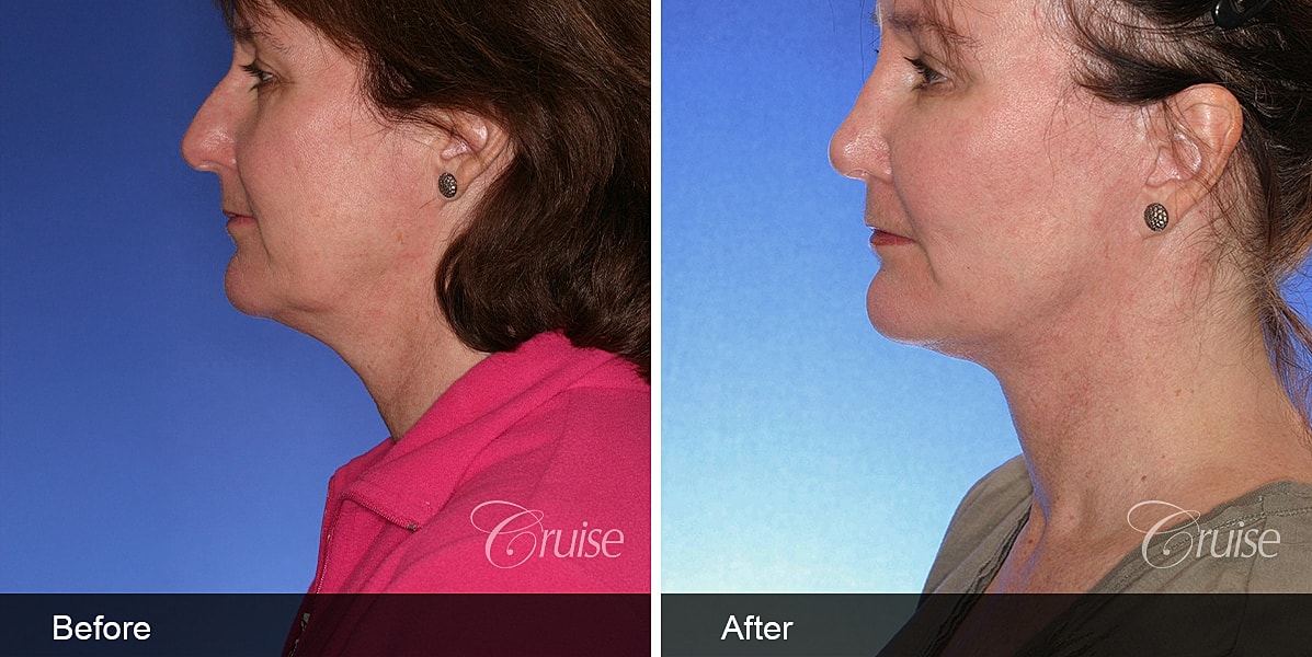 Neck Lift Before & After