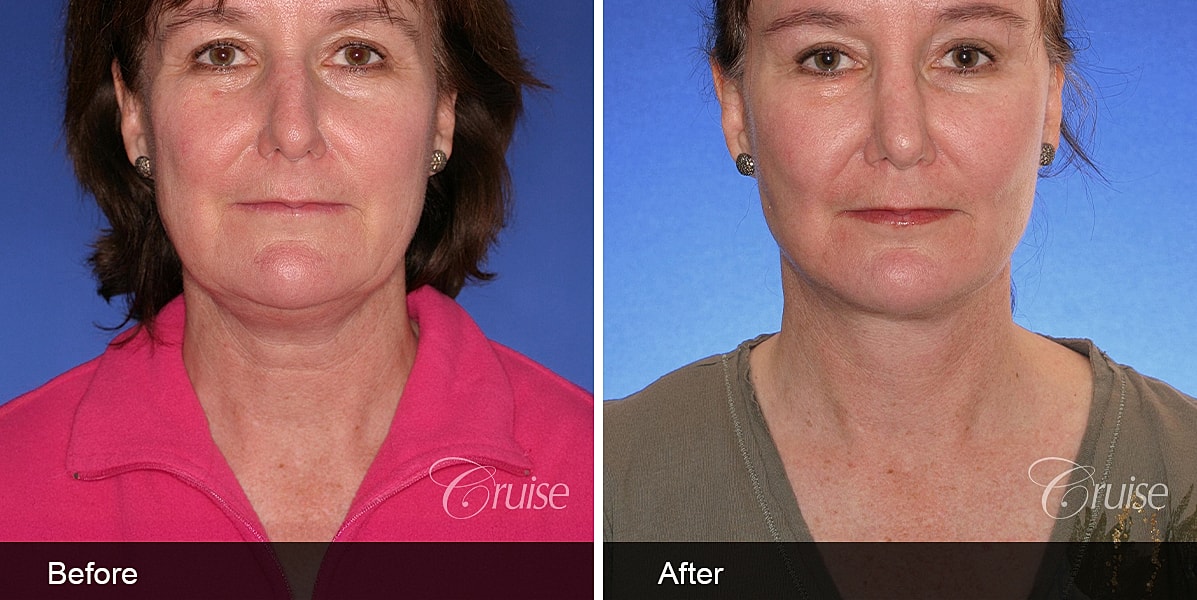 Neck Lift Before & After