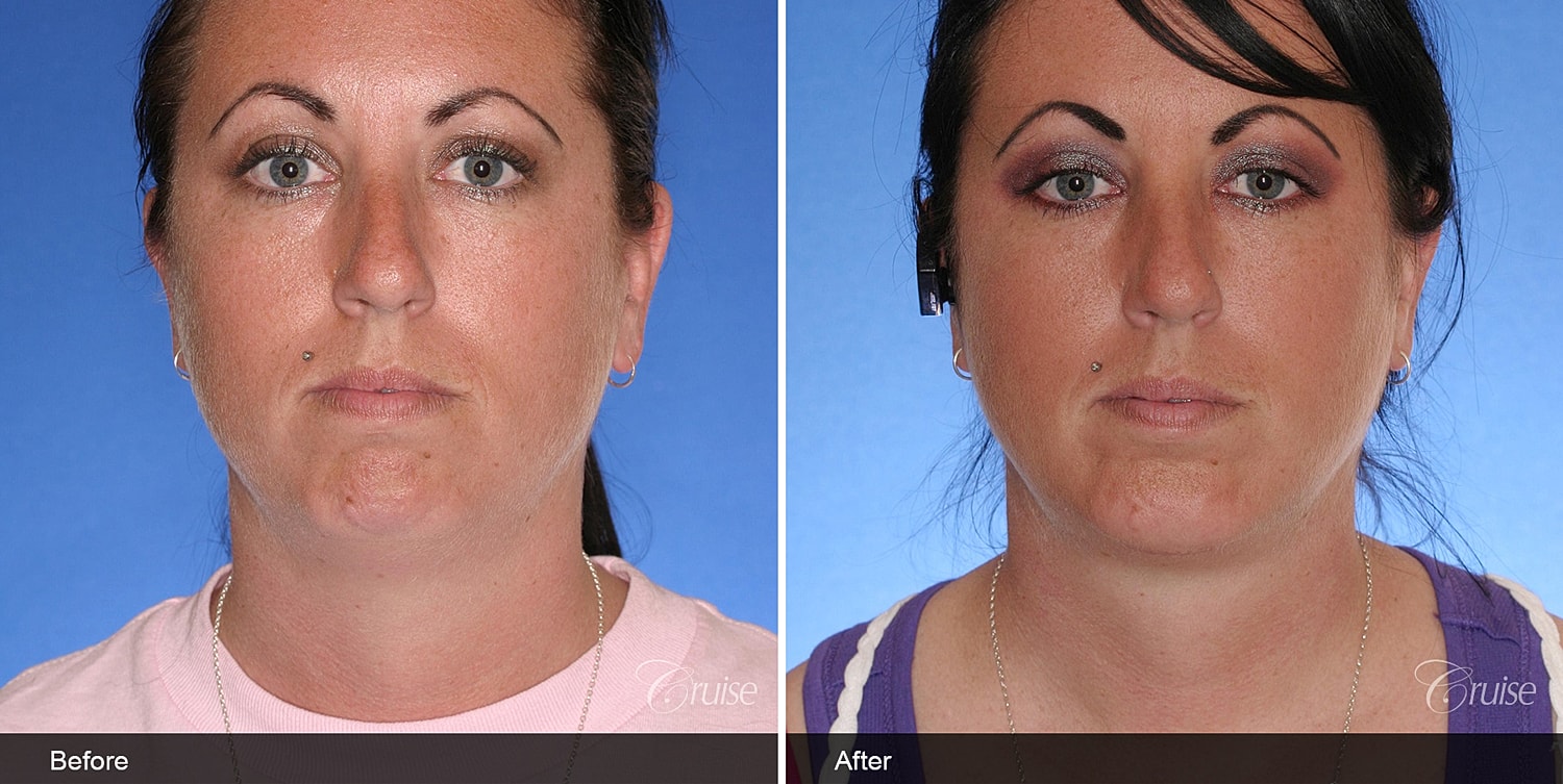 Neck Lift Before & After