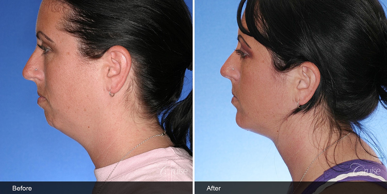 Neck Lift Before & After