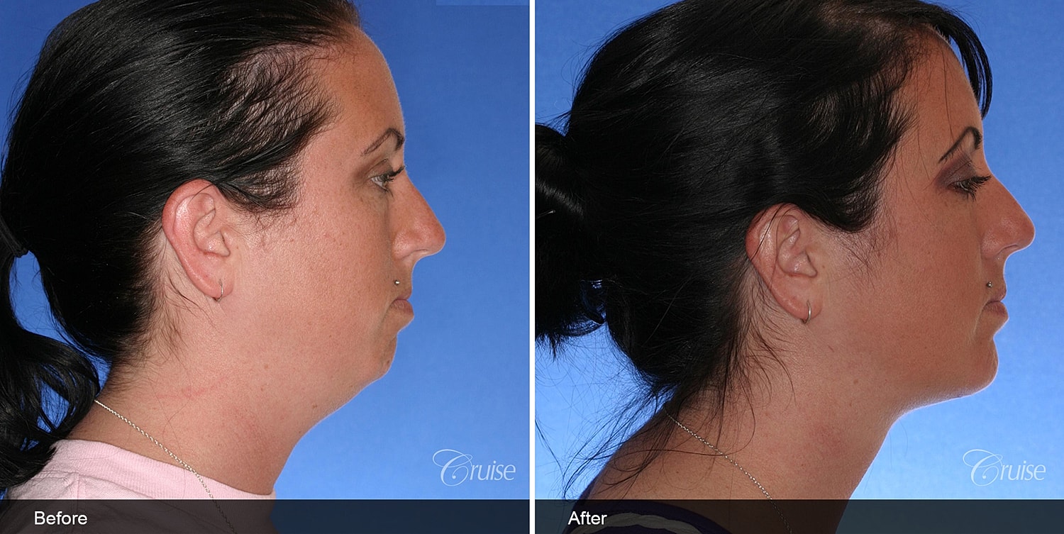 Neck Lift Before & After
