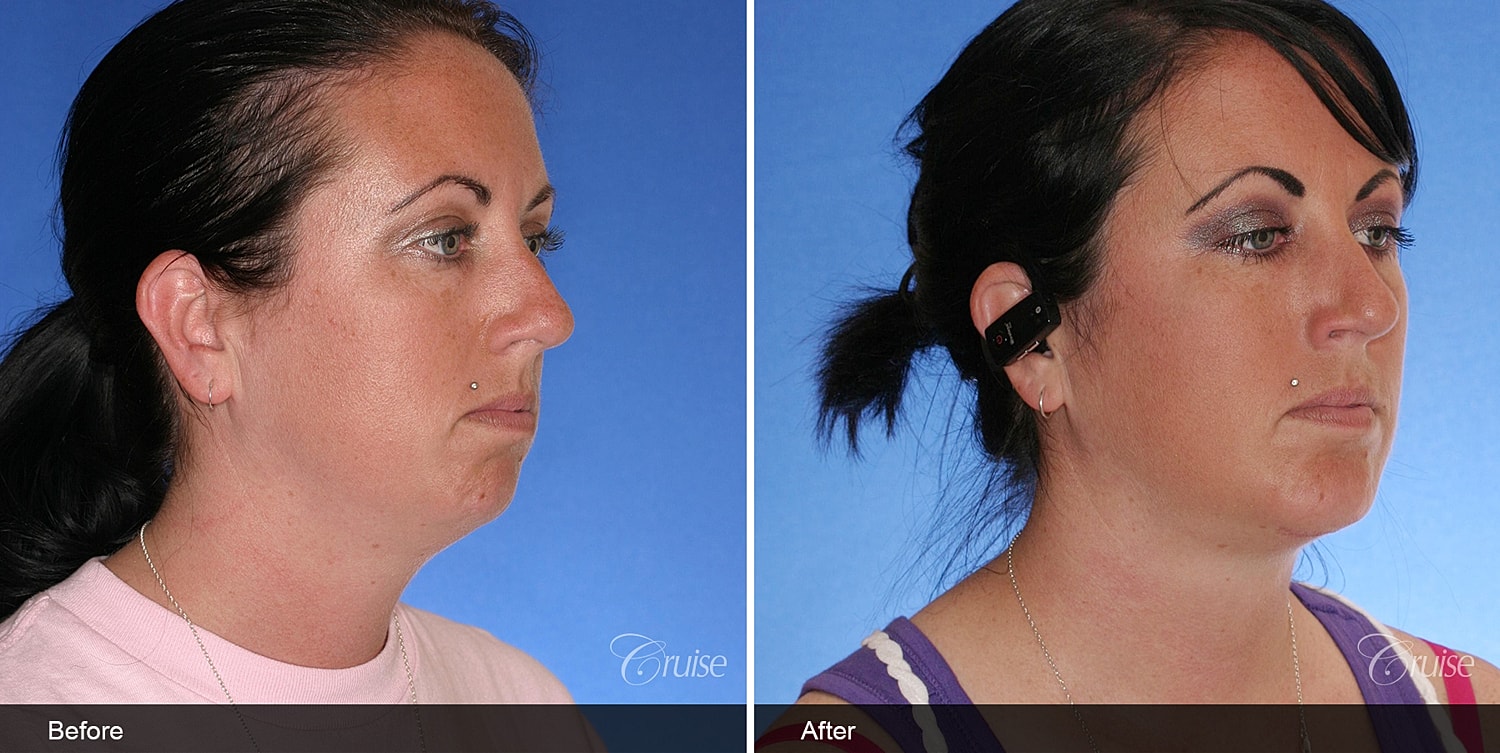Neck Lift Before & After