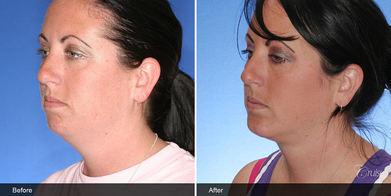 Neck Lift Before & After