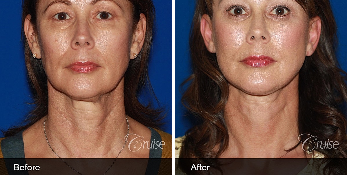 Neck Lift Before & After