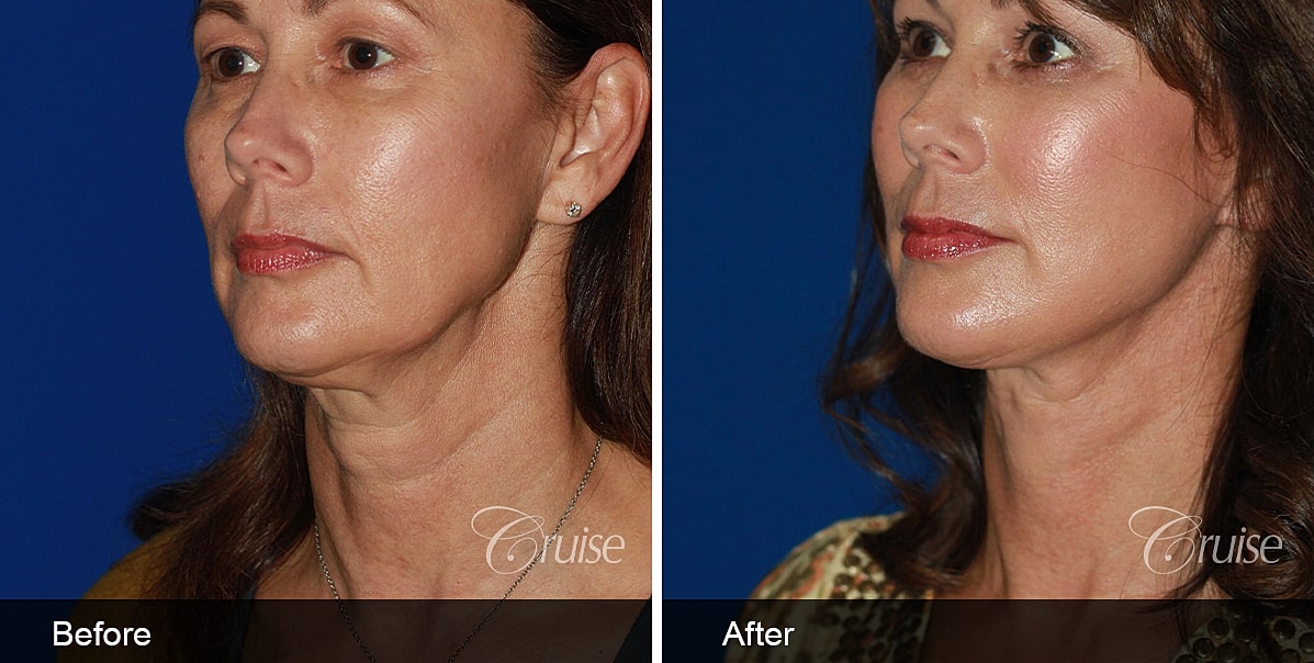 Neck Lift Before & After