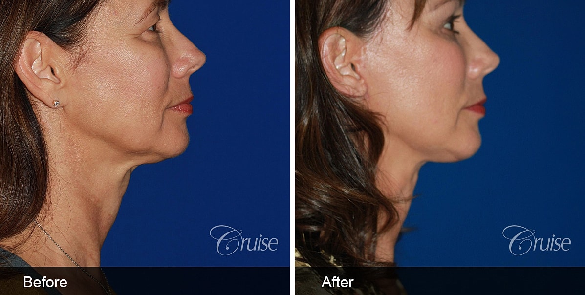 Neck Lift Before & After