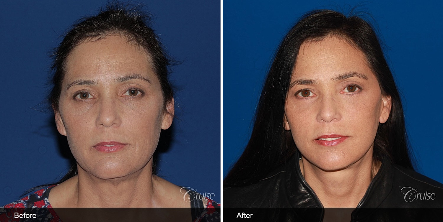 Neck Lift Before & After