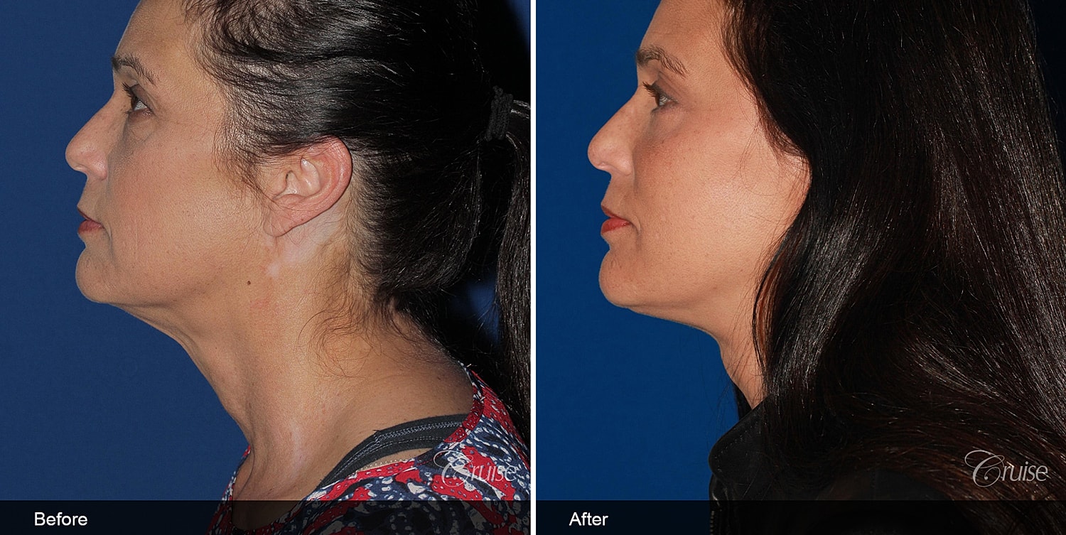 Neck Lift Before & After